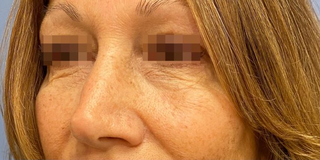 Fillers Before and After - Case 30, Image 3 - Female, age 35 – 44 - Baltimore, MD - Skin Therapeutics Med Spa