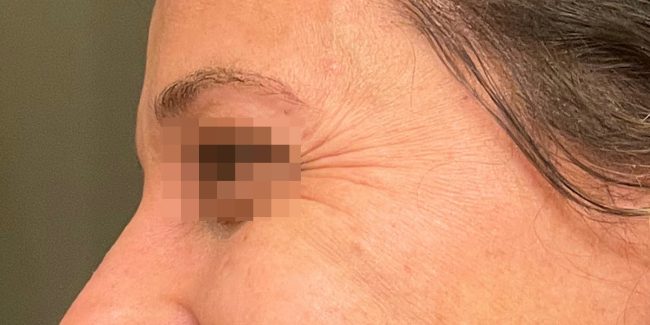 Dysport Before and After - Case 5, Image 3 - Female, age 25 – 34 - Baltimore, MD - Skin Therapeutics Med Spa