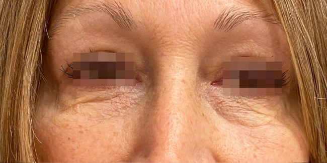 Fillers Before and After - Case 30, Image 5 - Female, age 35 – 44 - Baltimore, MD - Skin Therapeutics Med Spa