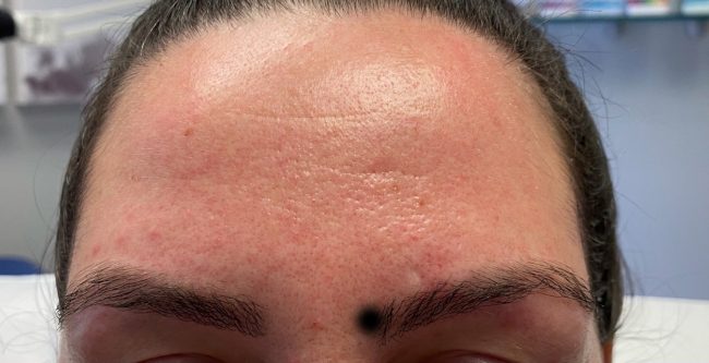 Dysport Before and After - Case -1, Image 1 - Female, age 35 – 44 - Baltimore, MD - Skin Therapeutics Med Spa