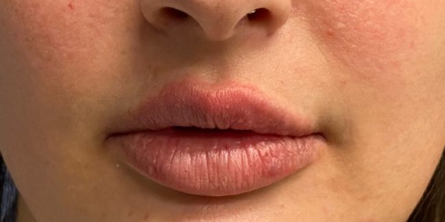 Fillers Before and After - Case 7, Image 2 - Female, age 18 – 24 - Baltimore, MD - Skin Therapeutics Med Spa