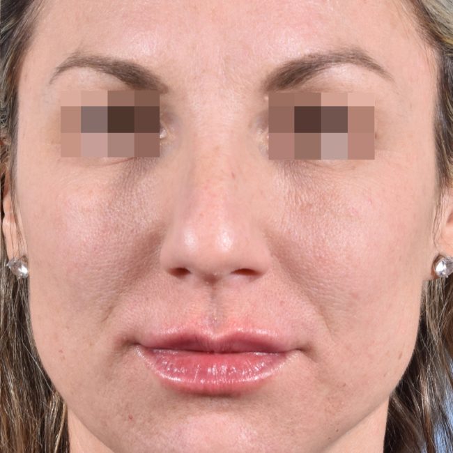 Fillers Before and After - Case 8, Image 2 - Female, age 25 – 34 - Baltimore, MD - Skin Therapeutics Med Spa