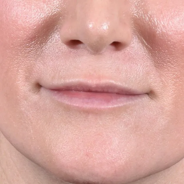 Fillers Before and After - Case 11, Image 2 - Female, age 35 – 44 - Baltimore, MD - Skin Therapeutics Med Spa