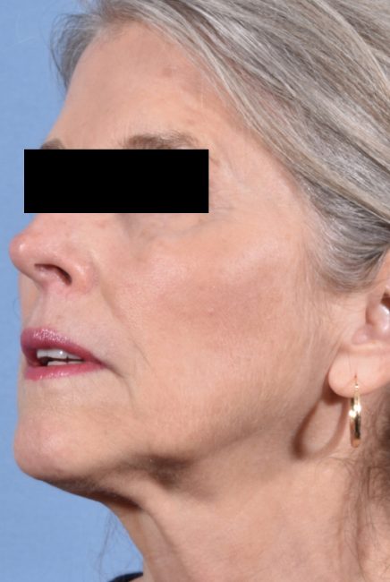 Fillers Before and After - Case 13, Image 2 - Female, age 55 – 64 - Baltimore, MD - Skin Therapeutics Med Spa