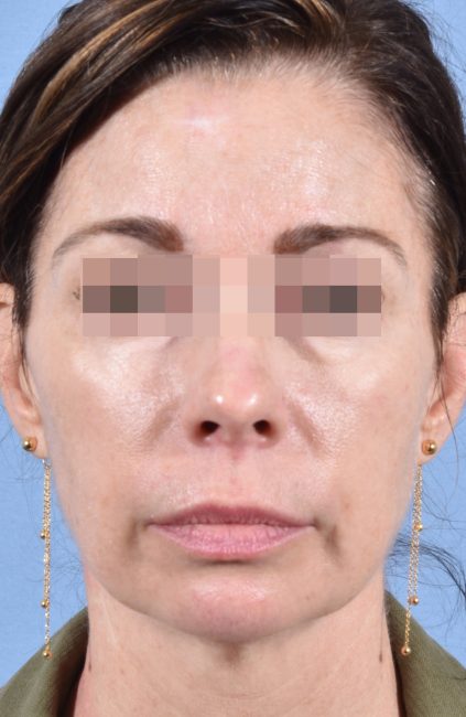 Fillers Before and After - Case 14, Image 2 - Female, age 35 – 44 - Baltimore, MD - Skin Therapeutics Med Spa