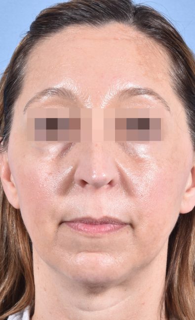 Fillers Before and After - Case 15, Image 2 - Female, age 35 – 44 - Baltimore, MD - Skin Therapeutics Med Spa