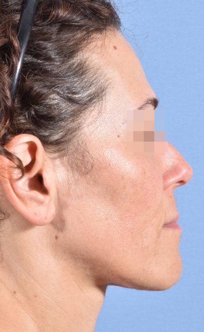 Fillers Before and After - Case 16, Image 2 - Female, age 35 – 44 - Baltimore, MD - Skin Therapeutics Med Spa