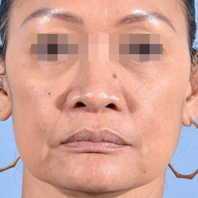 Fillers Before and After - Case 17, Image 2 - Female, age 35 – 44 - Baltimore, MD - Skin Therapeutics Med Spa