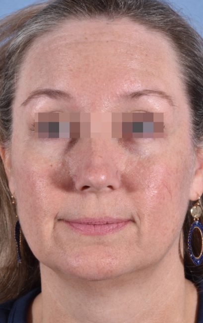 Fillers Before and After - Case 18, Image 2 - Female, age 35 – 44 - Baltimore, MD - Skin Therapeutics Med Spa