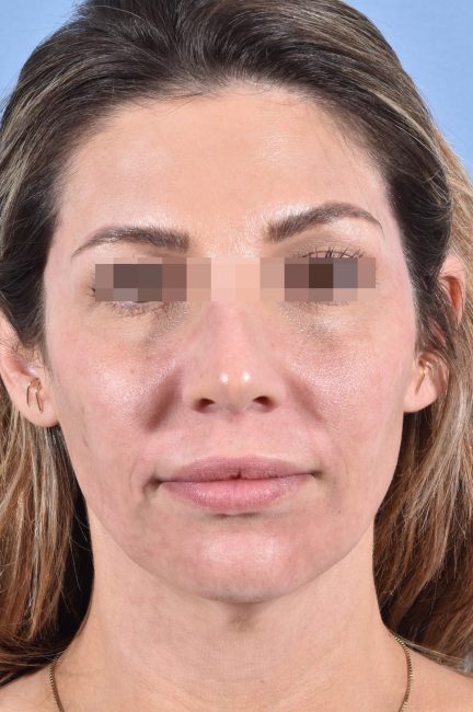 Fillers Before and After - Case 19, Image 2 - Female, age 25 – 34 - Baltimore, MD - Skin Therapeutics Med Spa