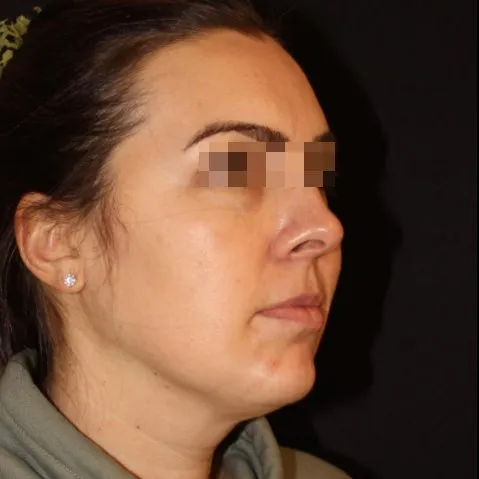 Fillers Before and After - Case 21, Image 2 - Female, age 25 – 34 - Baltimore, MD - Skin Therapeutics Med Spa