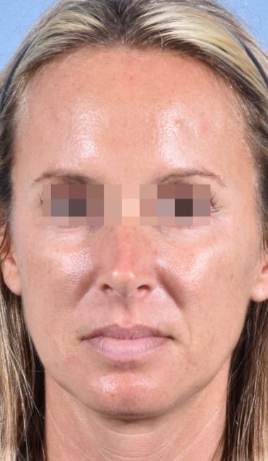 Fillers Before and After - Case 26, Image 2 - Female, age 25 – 34 - Baltimore, MD - Skin Therapeutics Med Spa