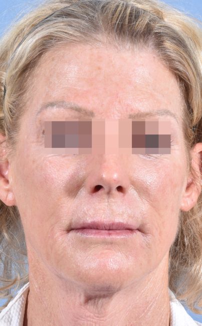 Fillers Before and After - Case 27, Image 2 - Female, age 45 – 54 - Baltimore, MD - Skin Therapeutics Med Spa