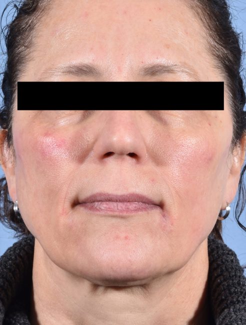 Fillers Before and After - Case 28, Image 2 - Female, age 45 – 54 - Baltimore, MD - Skin Therapeutics Med Spa