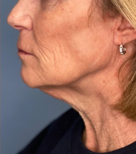 Fillers Before and After - Case 31, Image 2 - Female, age 45 – 54 - Baltimore, MD - Skin Therapeutics Med Spa