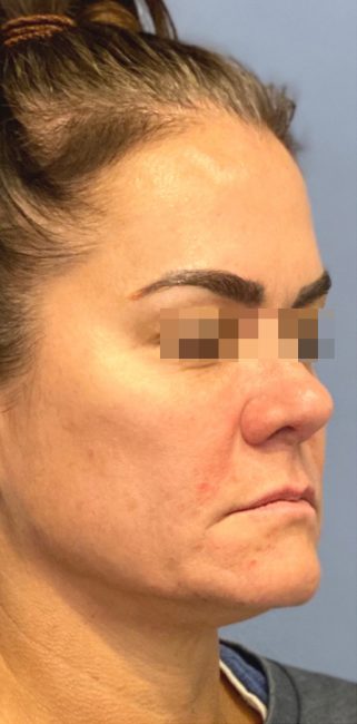 Fillers Before and After - Case 33, Image 2 - Female, age 35 – 44 - Baltimore, MD - Skin Therapeutics Med Spa