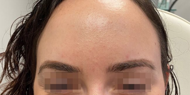 Dysport Before and After - Case 6, Image 2 - Female, age 25 – 34 - Baltimore, MD - Skin Therapeutics Med Spa