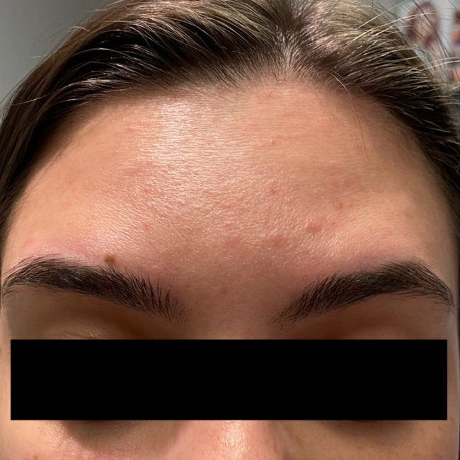 Dysport Before and After - Case 12, Image 2 - Female, age 25 – 34 - Baltimore, MD - Skin Therapeutics Med Spa