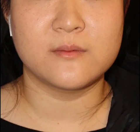 Botox Before and After - Case 10, Image 2 - Female, age 25 – 34 - Baltimore, MD - Skin Therapeutics Med Spa