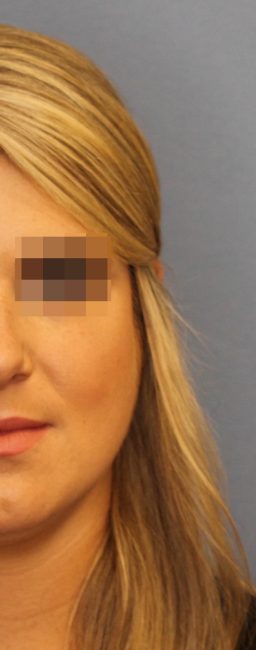 Botox Before and After - Case 11, Image 2 - Female, age 25 – 34 - Baltimore, MD - Skin Therapeutics Med Spa