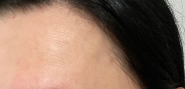 IPL Before and After - Case 2, Image 2 - Female, age 35 – 44 - Baltimore, MD - Skin Therapeutics Med Spa