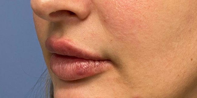 Fillers Before and After - Case 7, Image 4 - Female, age 18 – 24 - Baltimore, MD - Skin Therapeutics Med Spa