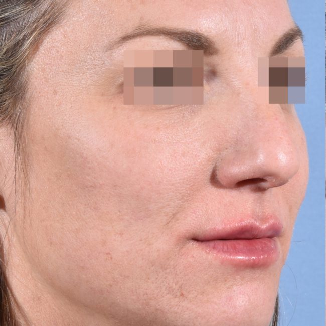 Fillers Before and After - Case 8, Image 4 - Female, age 25 – 34 - Baltimore, MD - Skin Therapeutics Med Spa