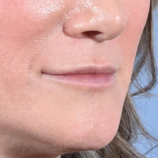 Fillers Before and After - Case 11, Image 4 - Female, age 35 – 44 - Baltimore, MD - Skin Therapeutics Med Spa