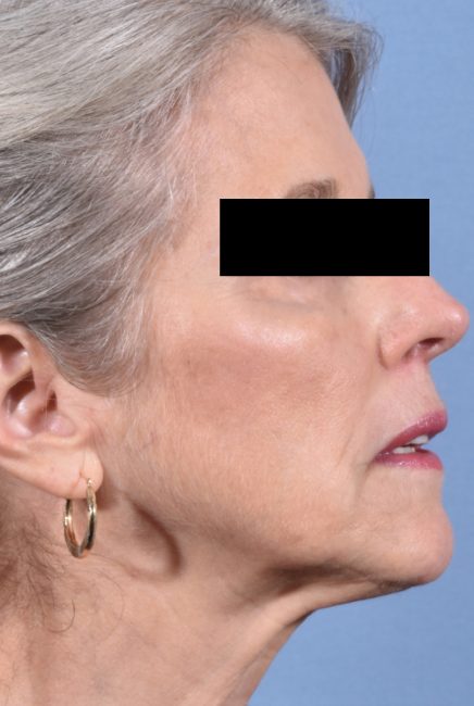 Fillers Before and After - Case 13, Image 4 - Female, age 55 – 64 - Baltimore, MD - Skin Therapeutics Med Spa