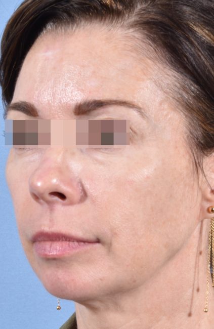 Fillers Before and After - Case 14, Image 4 - Female, age 35 – 44 - Baltimore, MD - Skin Therapeutics Med Spa