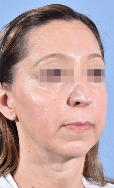 Fillers Before and After - Case 15, Image 4 - Female, age 35 – 44 - Baltimore, MD - Skin Therapeutics Med Spa