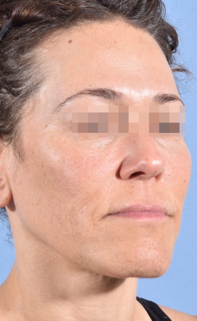 Fillers Before and After - Case 16, Image 4 - Female, age 35 – 44 - Baltimore, MD - Skin Therapeutics Med Spa