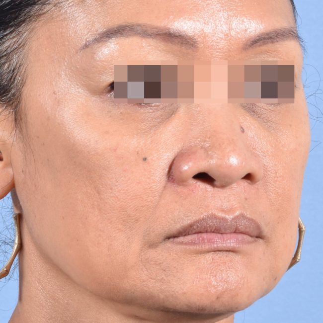 Fillers Before and After - Case 17, Image 4 - Female, age 35 – 44 - Baltimore, MD - Skin Therapeutics Med Spa