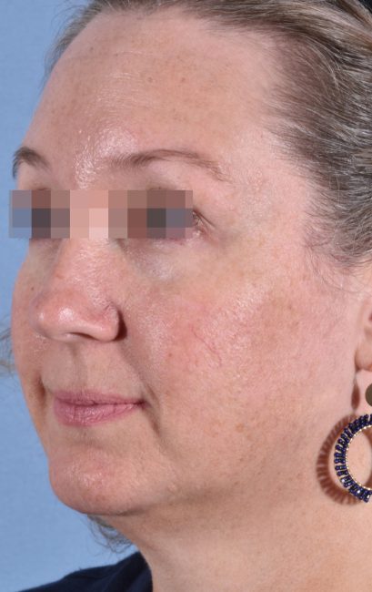 Fillers Before and After - Case 18, Image 4 - Female, age 35 – 44 - Baltimore, MD - Skin Therapeutics Med Spa