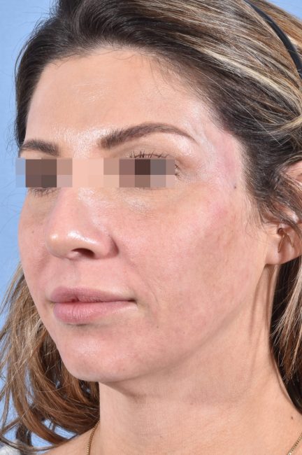 Fillers Before and After - Case 19, Image 4 - Female, age 25 – 34 - Baltimore, MD - Skin Therapeutics Med Spa