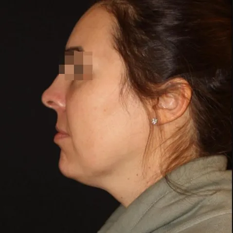 Fillers Before and After - Case 21, Image 4 - Female, age 25 – 34 - Baltimore, MD - Skin Therapeutics Med Spa