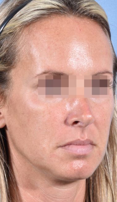 Fillers Before and After - Case 26, Image 4 - Female, age 25 – 34 - Baltimore, MD - Skin Therapeutics Med Spa