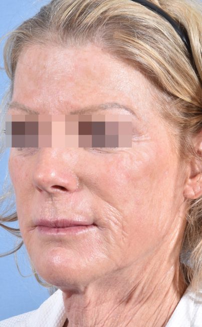 Fillers Before and After - Case 27, Image 4 - Female, age 45 – 54 - Baltimore, MD - Skin Therapeutics Med Spa