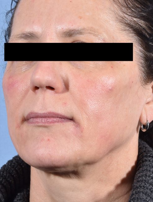 Fillers Before and After - Case 28, Image 4 - Female, age 45 – 54 - Baltimore, MD - Skin Therapeutics Med Spa