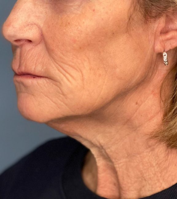 Fillers Before and After - Case 31, Image 4 - Female, age 45 – 54 - Baltimore, MD - Skin Therapeutics Med Spa