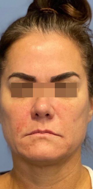 Fillers Before and After - Case 33, Image 4 - Female, age 35 – 44 - Baltimore, MD - Skin Therapeutics Med Spa