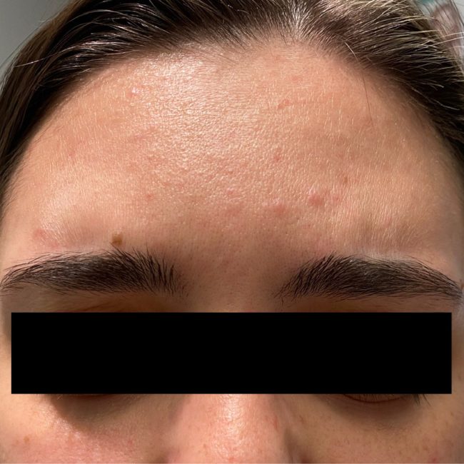 Dysport Before and After - Case 12, Image 4 - Female, age 25 – 34 - Baltimore, MD - Skin Therapeutics Med Spa