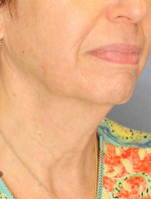 RF Microneedling Before and After - Case -1, Image 2 - Female, age 45 – 54 - Baltimore, MD - Skin Therapeutics Med Spa