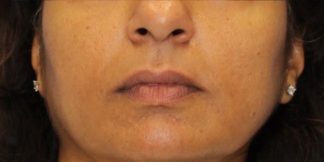 RF Microneedling Before and After - Case 2, Image 2 - Female, age 35 – 44 - Baltimore, MD - Skin Therapeutics Med Spa