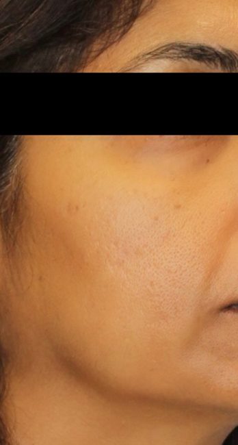 RF Microneedling Before and After - Case 3, Image 2 - Female, age 35 – 44 - Baltimore, MD - Skin Therapeutics Med Spa