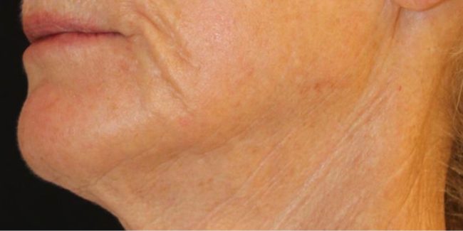 RF Microneedling Before and After - Case 4, Image 3 - Female, age 55 – 64 - Baltimore, MD - Skin Therapeutics Med Spa