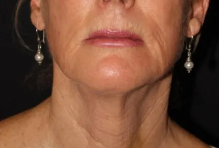 RF Microneedling Before and After - Case 4, Image 2 - Female, age 55 – 64 - Baltimore, MD - Skin Therapeutics Med Spa