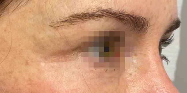 Plasma IQ Before and After - Case 2, Image 2 - Female, age 35 – 44 - Baltimore, MD - Skin Therapeutics Med Spa