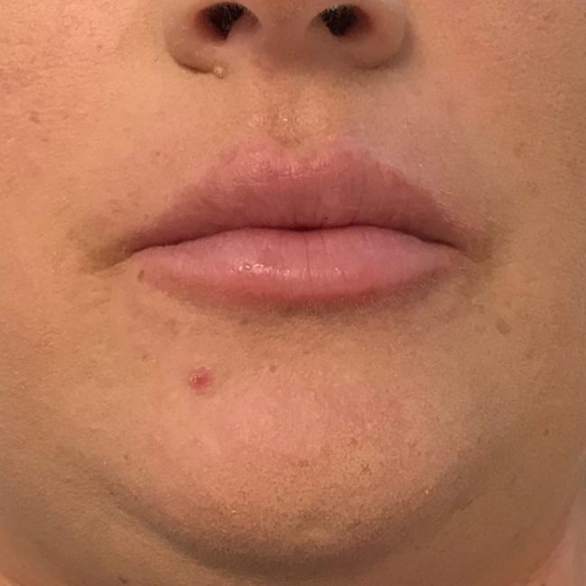 Fillers Before and After - Case 5, Image 2 - Female, age 25 – 34 - Baltimore, MD - Skin Therapeutics Med Spa