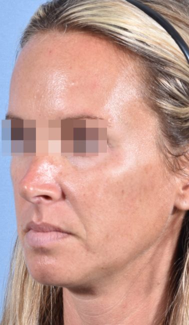 Fillers Before and After - Case 26, Image 6 - Female, age 25 – 34 - Baltimore, MD - Skin Therapeutics Med Spa